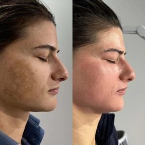Peeling