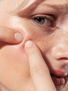 acne