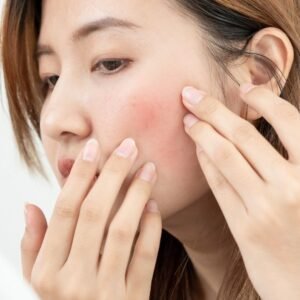 rosacea
