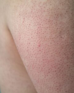 Queratosis Pilaris: Exfoliación Química vs Física