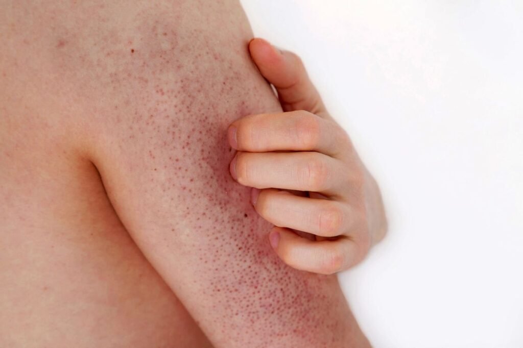 Queratosis Pilaris: Exfoliación Química vs Física