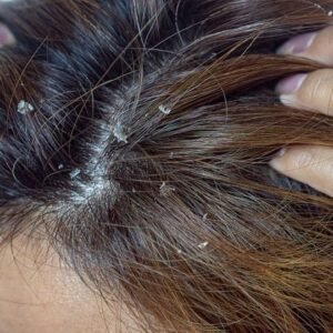 Dermatitis Seborreica: Tratamientos Efectivos